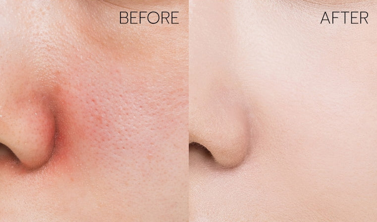 Sebum, Remove Dead Skin, Achieve, Beauty