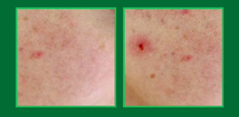 Patch, Microneedles, Treatment, Absorption, Skin Care