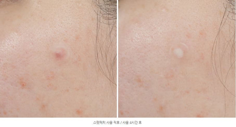 SOME BY MI Clear Spot Patch 18ocs Korean skincare Kbeauty Cosmetics