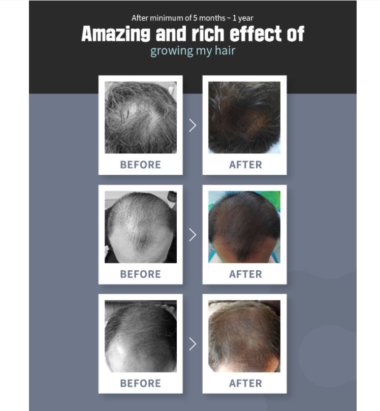 Moisturizing, Rich effects of growing hair, contains a large amount of ingredients created with the best mixing ratio, Minimum of 5 months, Hair growth
